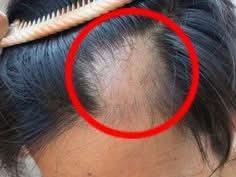 Kit Anticaída Capilar (Hombre)