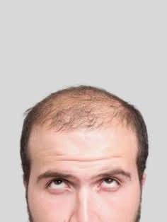 Kit Anticaída Capilar (Hombre)